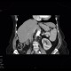 Metastasis of renal cell carcinoma in pancreas and adrenal gland, nephrectomy: CT - Computed tomography